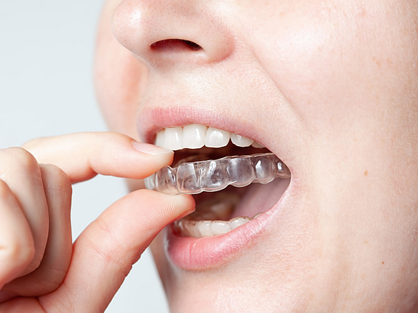 画像：矯正治療を開始