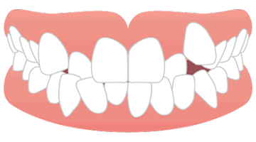 画像：八重歯・乱ぐい歯（叢生・そうせい）