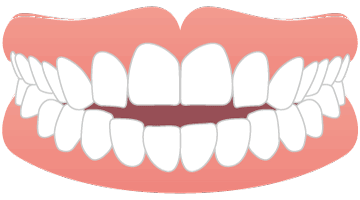 画像：オープンバイト（開咬）