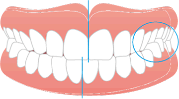 画像：いびき治療