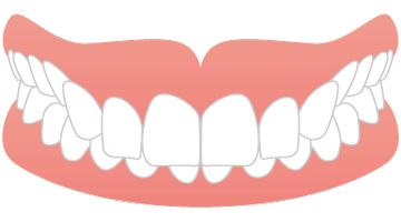 画像：深いかみ合わせ（過蓋咬合）