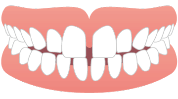 画像：すきっ歯（空隙歯列）