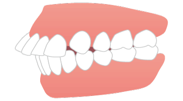 画像：出っ歯（上あご前突）