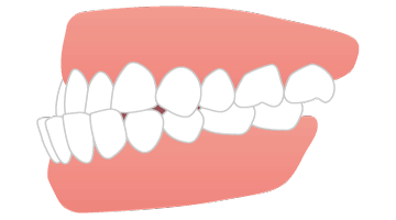 画像：受け口（反対咬合）