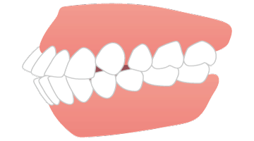 画像：いびき治療